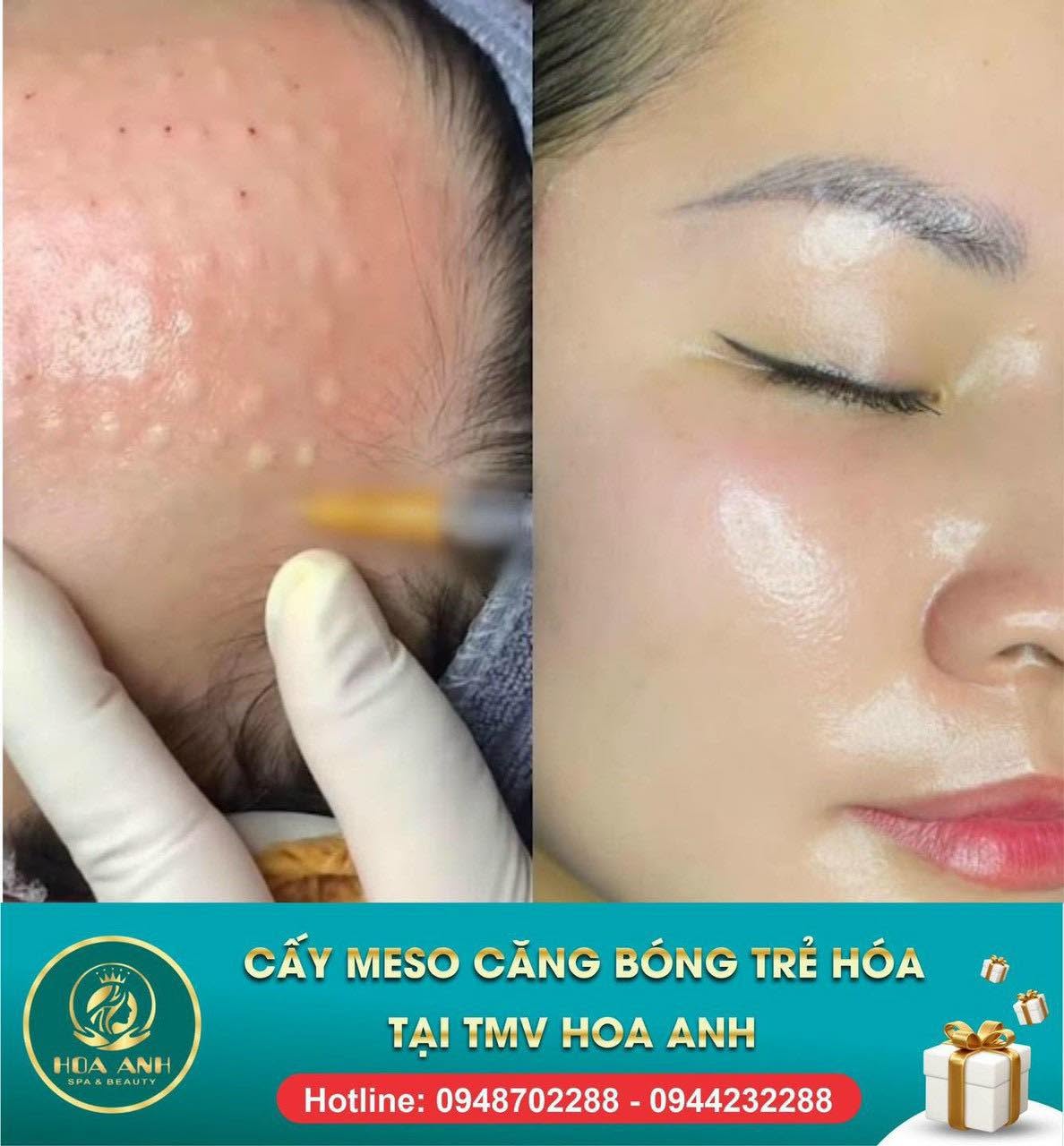 Quy trình tiêm Meso và kết quả da căng bóng tại Hoa Anh